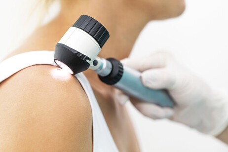 Melanoma, con super-immunoterapia sopravvivenza al 72%