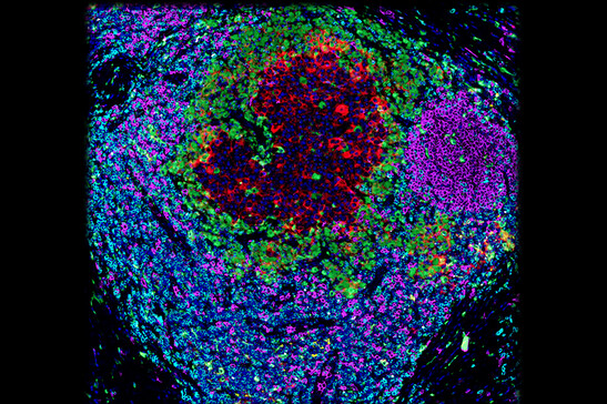 Una cellula tumorale circondata da cellule immunitarie (fonte: Romain Remark, Miriam Merad, e Sacha Gnjatic/Innate Pharma and Icahn School of Medicine at Mount Sinai)