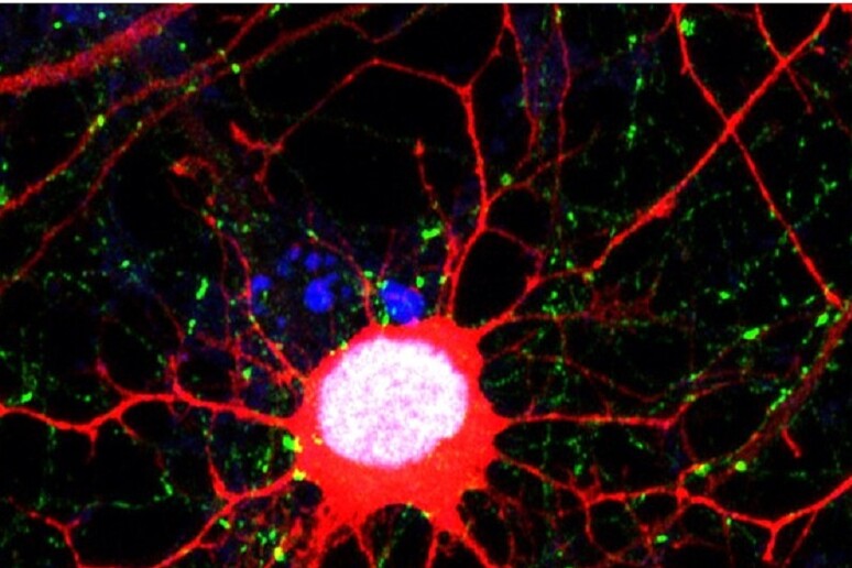 A glioblastoma cell  after the tumor came back (credit: Cancer Cell) -     RIPRODUZIONE RISERVATA