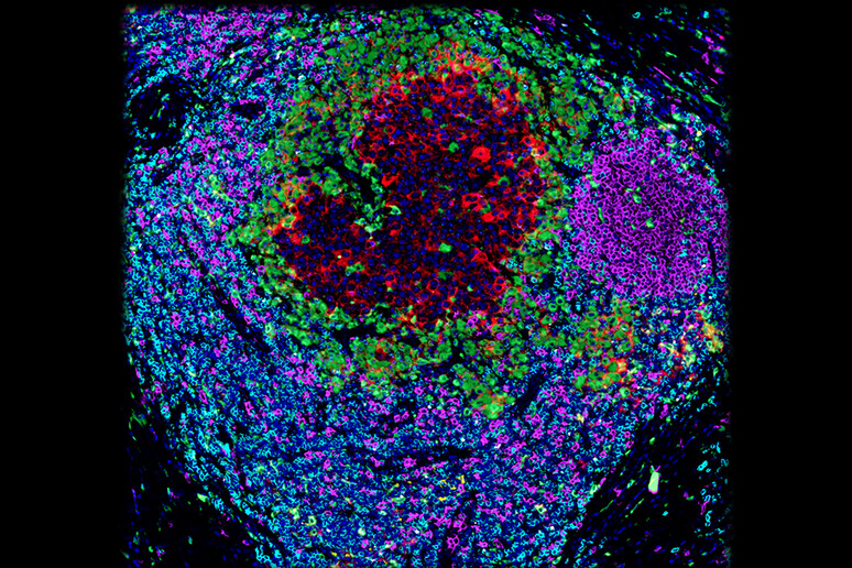 Una cellula tumorale circondata da cellule immunitarie (fonte: Romain Remark, Miriam Merad, e Sacha Gnjatic/Innate Pharma and Icahn School of Medicine at Mount Sinai) - RIPRODUZIONE RISERVATA